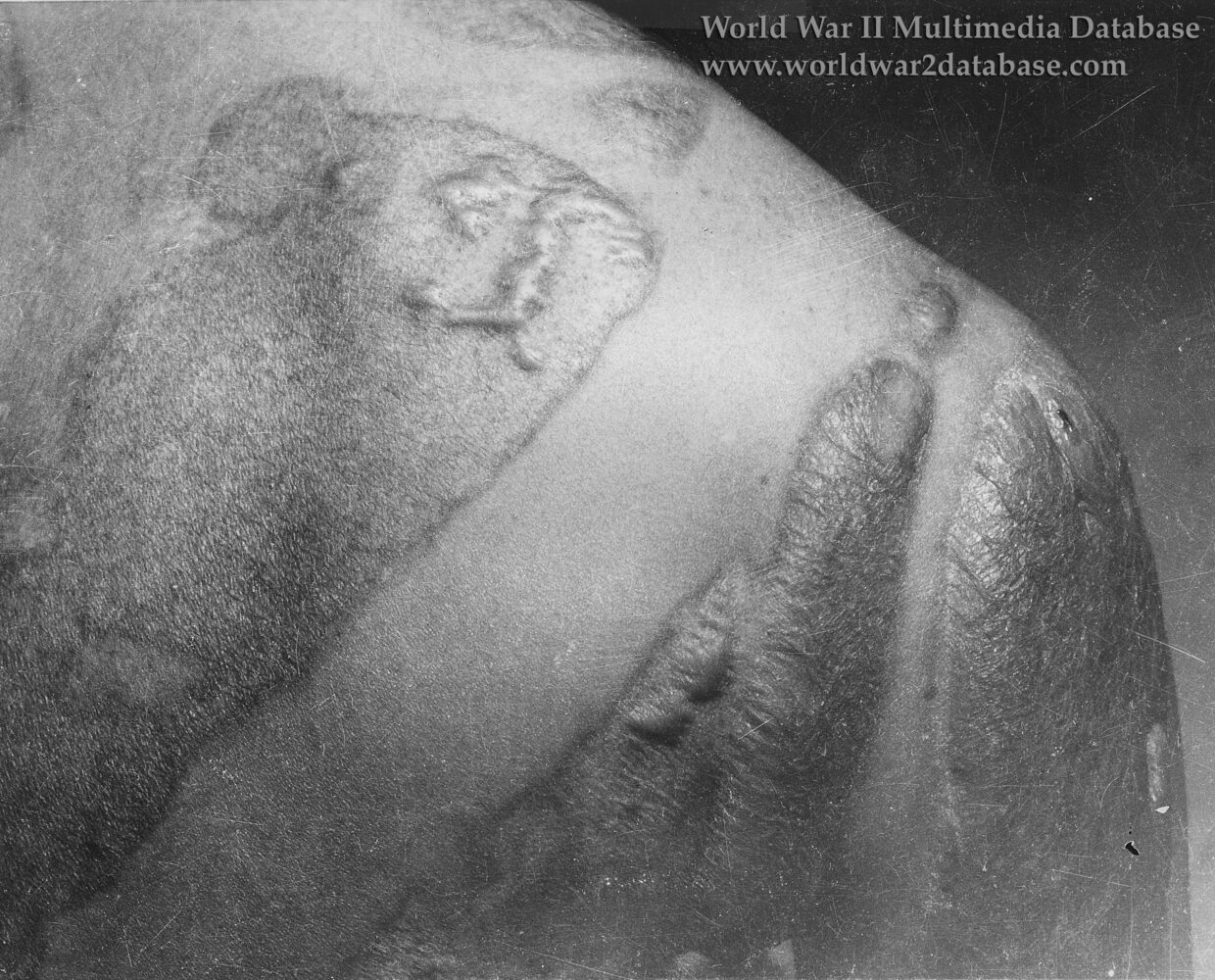 Keloid Scars on the Back of a Hibakusha