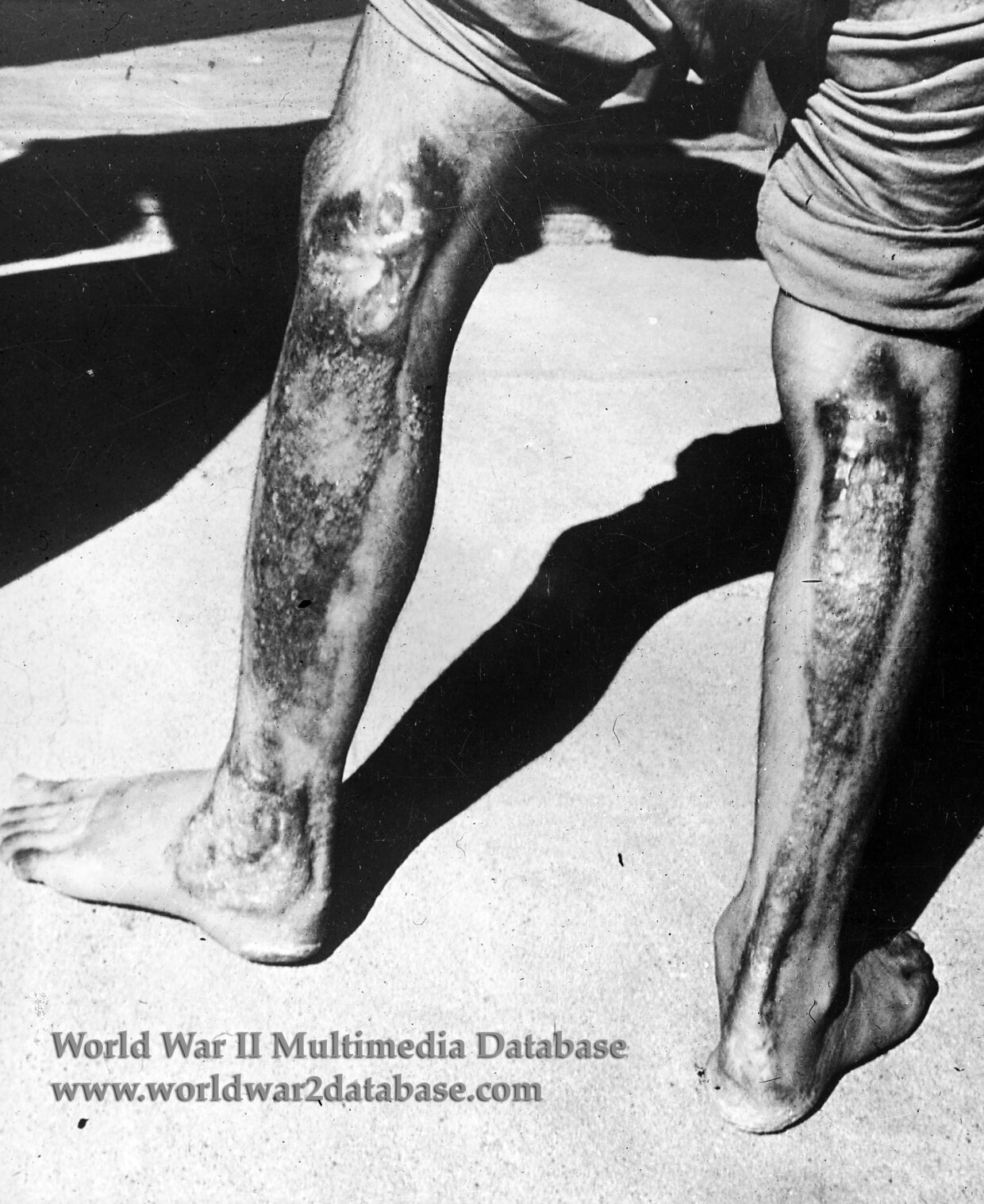 Japanese Soldier Hibakusha From Hiroshima Developing Keloid Scars